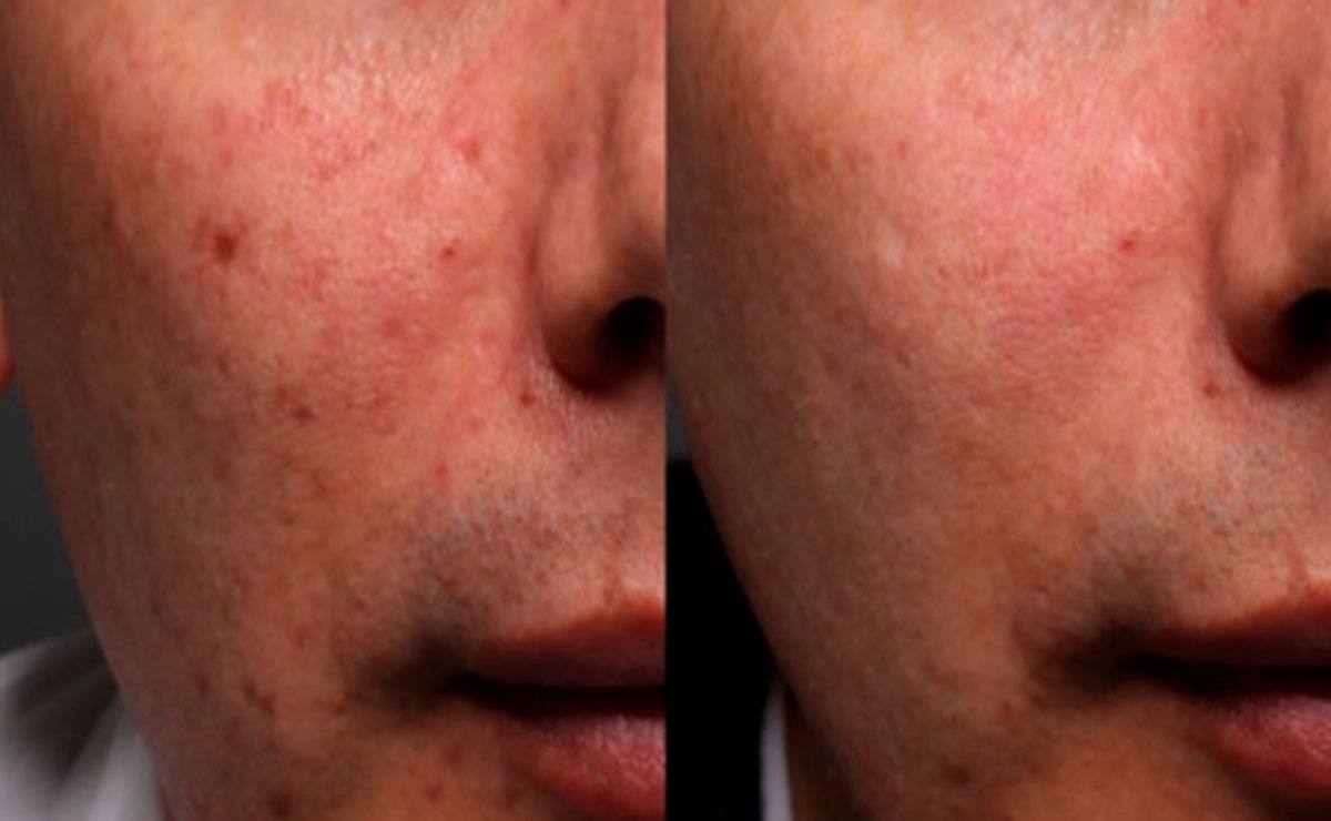 Cicatrices causadas por el acné - ULP