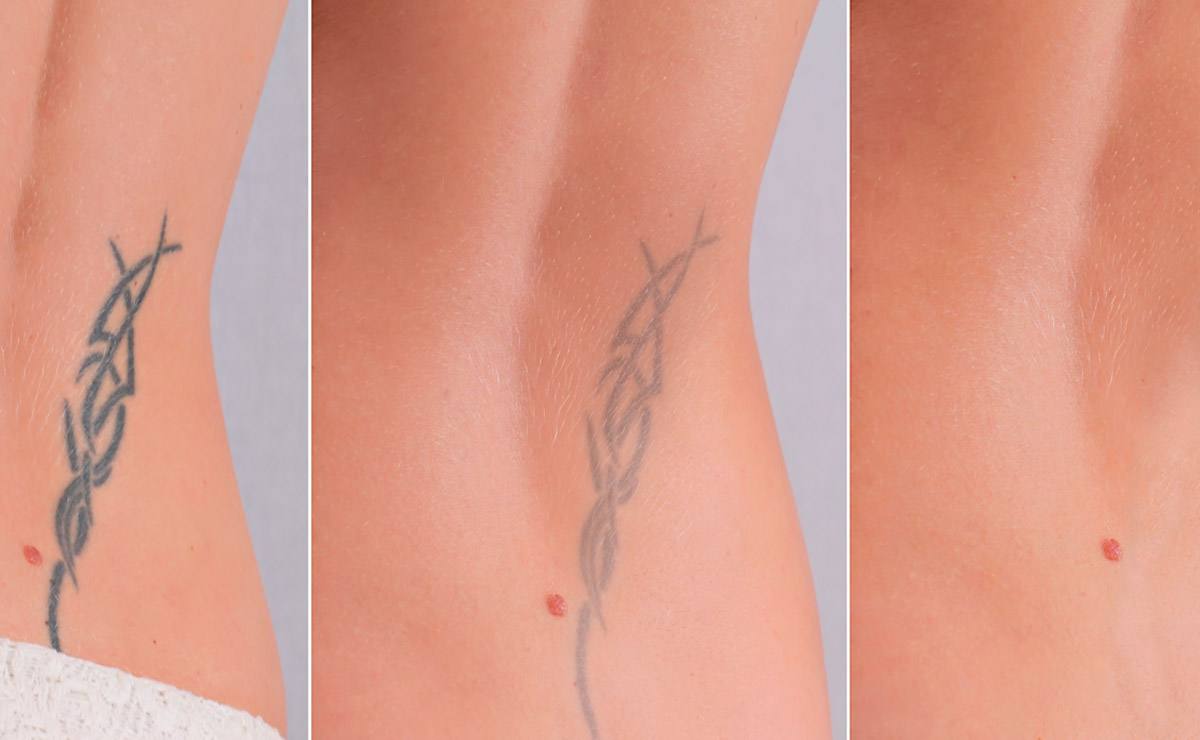 Depilación láser con tatuajes, lunares o heridas en la piel