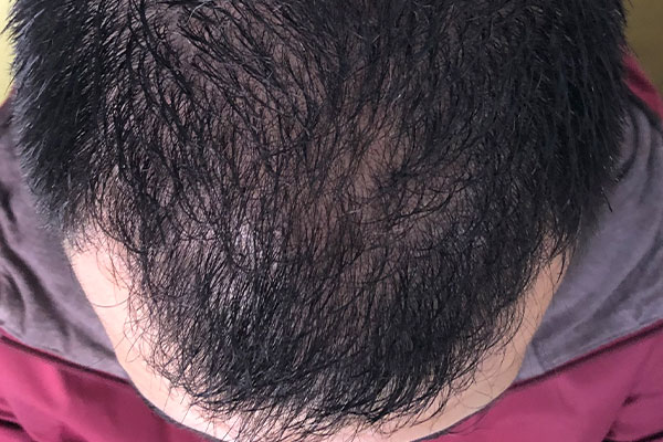 Caso 01 - después Alopecia ULP