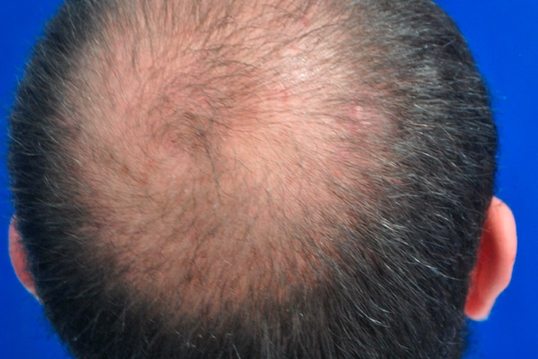 Imagen Alopecia Hombre 08 - ULP