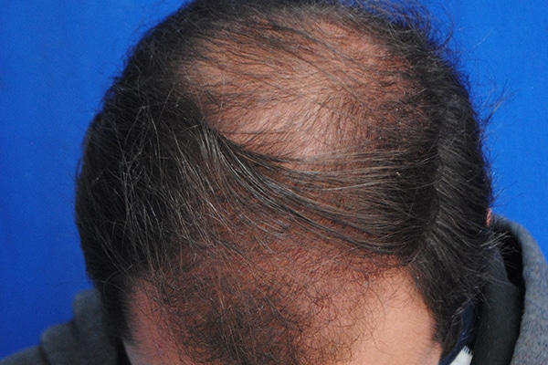 Imagen Alopecia Hombre 05 - ULP