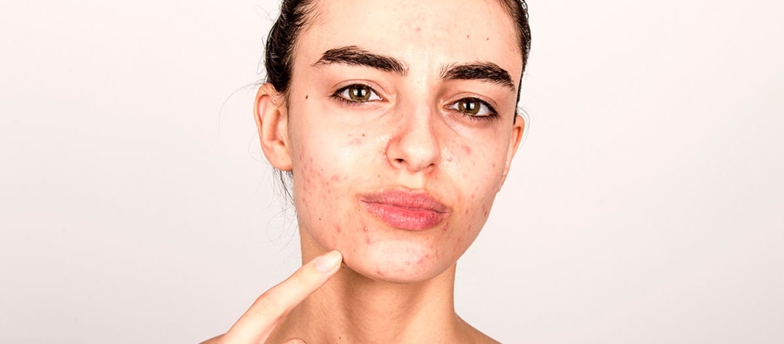 El acné y sus cicatrices causadas en tiempos de pandemia - ULP