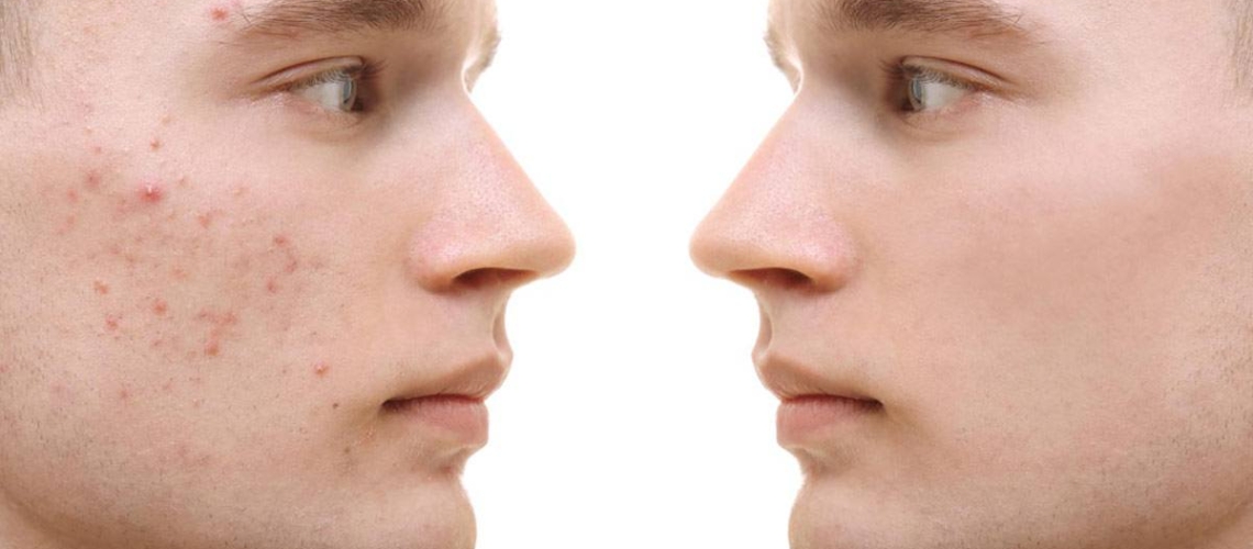 Mitos y dudas sobre el acné - ULP
