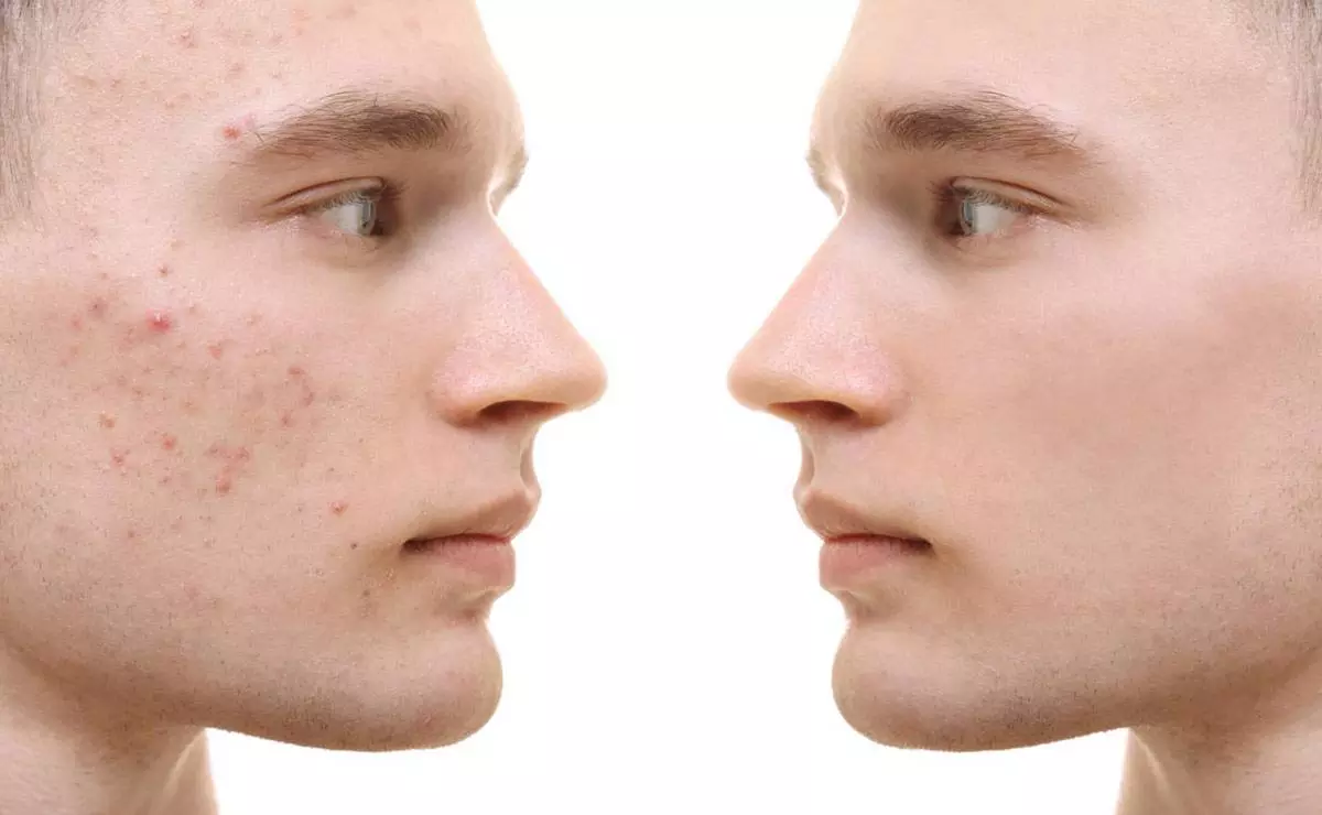 Mitos y dudas sobre el acné - ULP